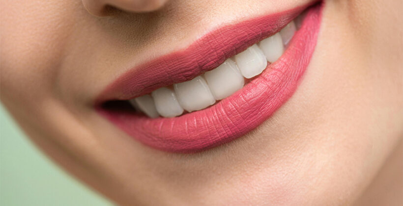 Blanqueamiento dental