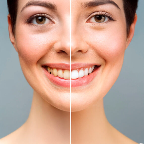 Blanqueamiento dental