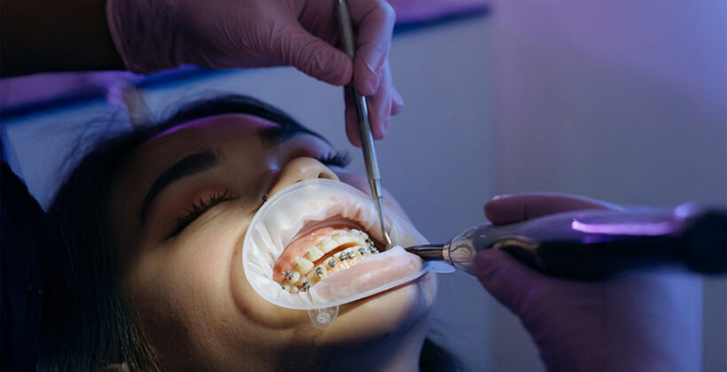 ¿Por qué la limpieza dental no es solo una cuestión estética?