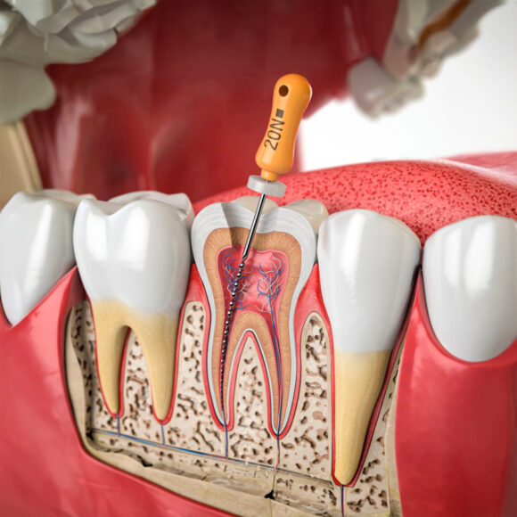 Endodoncia
